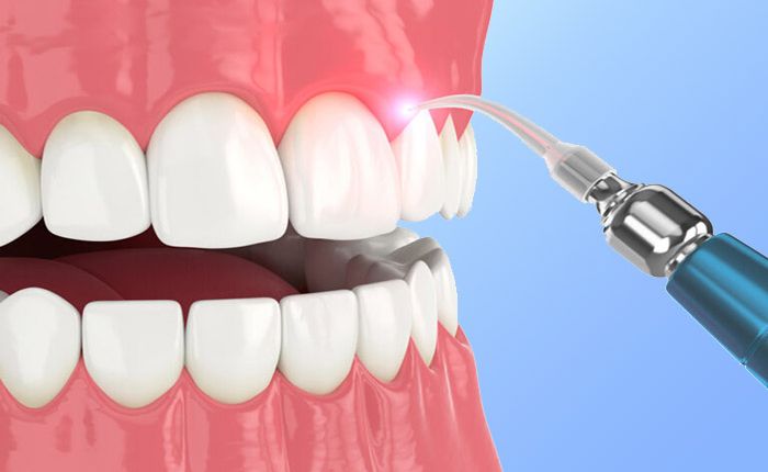 Laser dentales