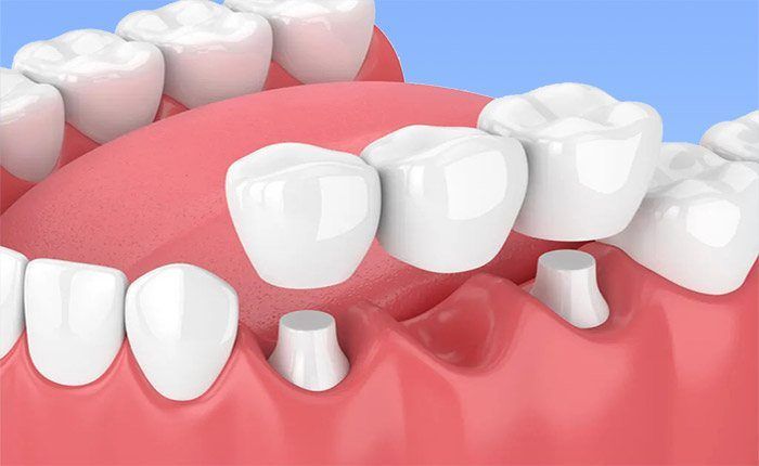 puentes dentales